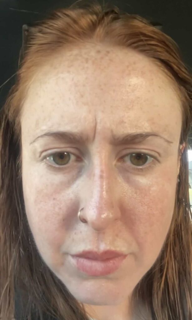 Hannah before botox frowning 