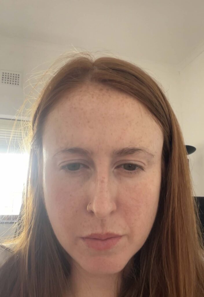 Hannah botox after shot